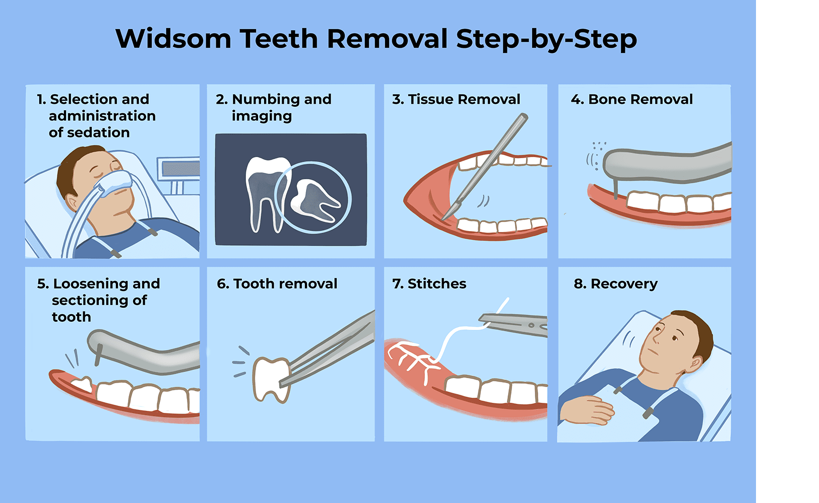 Read more about the article Wisdom Tooth Removal: What You Need to Know