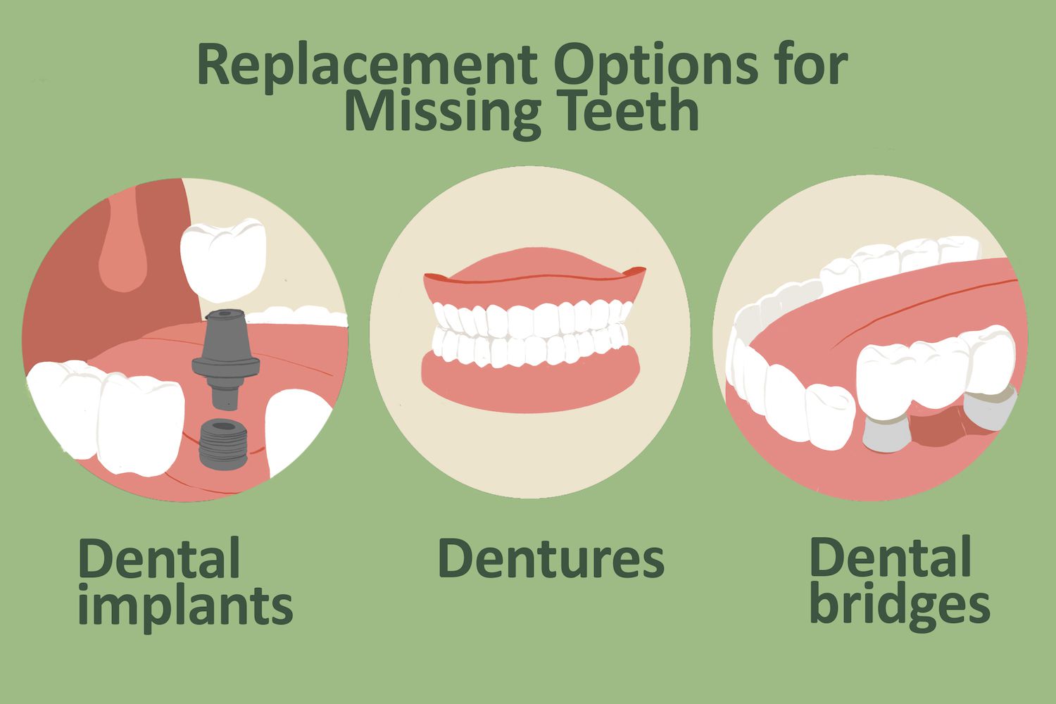 Read more about the article A Comprehensive Guide to Teeth Replacement Options: Your Path to a Confident Smile