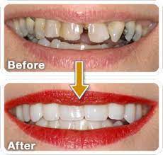 Read more about the article The Art of Smile Designing: Crafting Your Perfect Smile