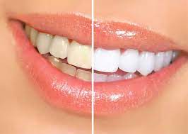 Read more about the article The Ultimate Guide to Teeth Whitening: Tips, Methods, and Myths