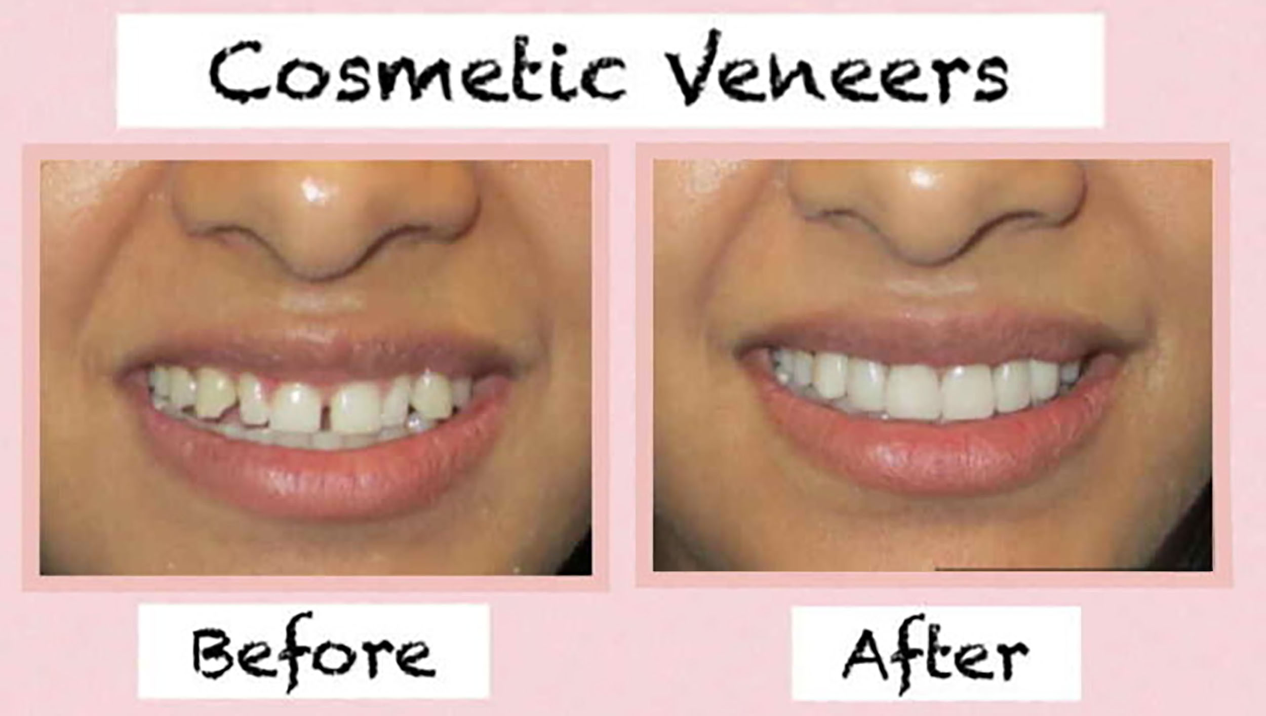 Read more about the article “Dental Laminates: Transforming Smiles with Thin Porcelain Veneers”