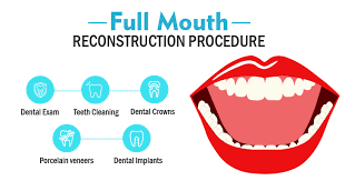 Read more about the article Transforming Smiles: The Complete Guide to Full Mouth Rehabilitation Treatment