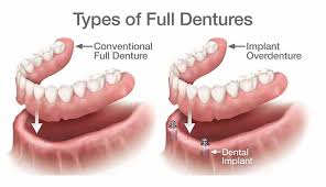 Read more about the article A Comprehensive Guide to Dental Dentures: Types, Care, and Benefits