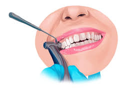 Read more about the article The Ultimate Guide to Teeth Cleaning: Tips for a Healthy Smile