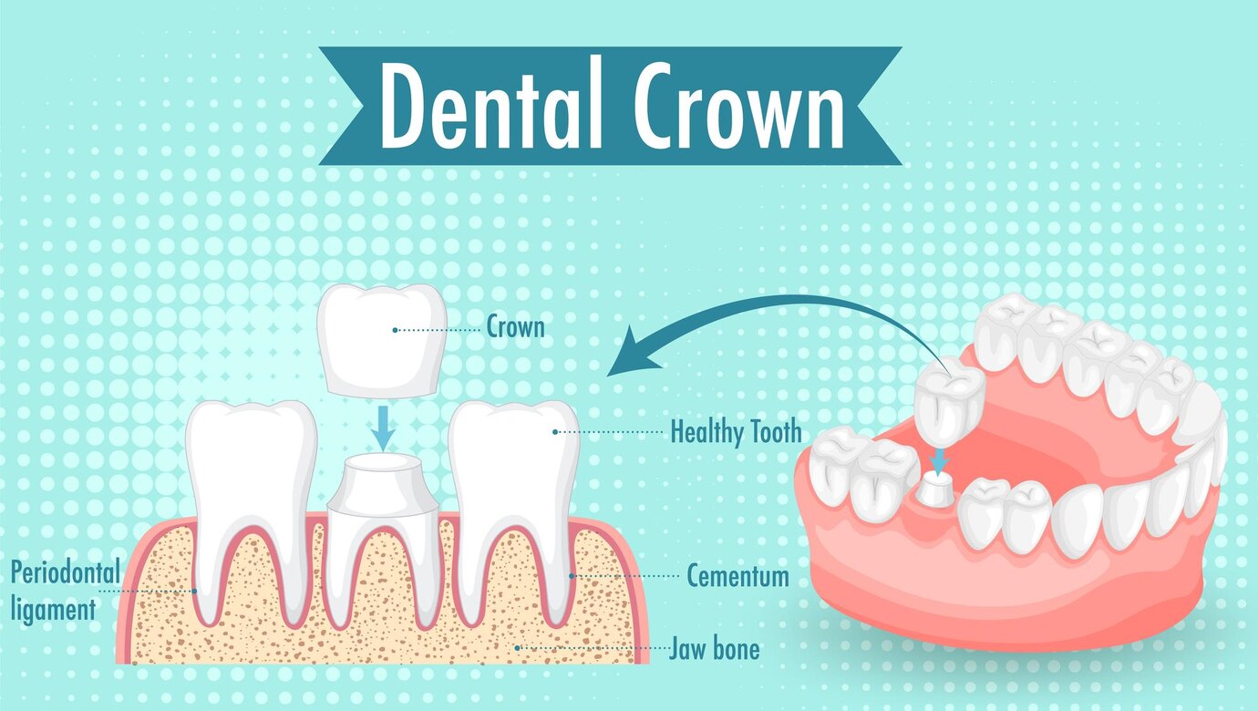 Read more about the article “Dental Crown: Restoring Your Smile and Oral Health”