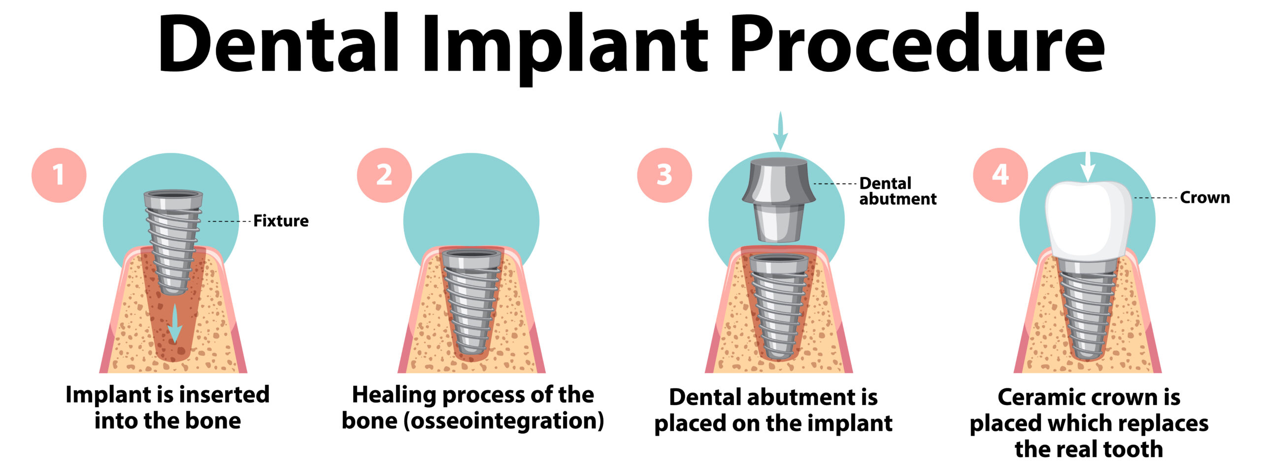 Read more about the article Unveiling the Wonders of Dental Implants: A Permanent Solution to Missing Teeth