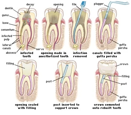 Read more about the article Demystifying Root Canal Treatment: What You Need to Know